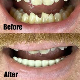 Instant Smile Teeth Lower Veneer - Flexible - image 2 thumbnail